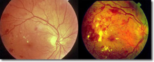 diabeticretinopathy4